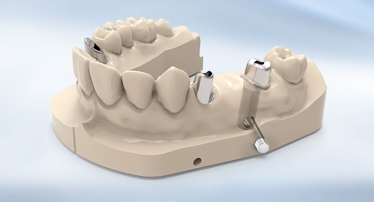 digital intra model dental concept